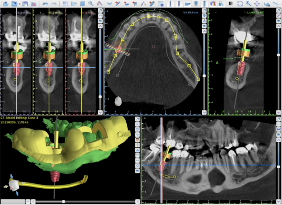 Cirurgia Guiada — Planeamento Digital