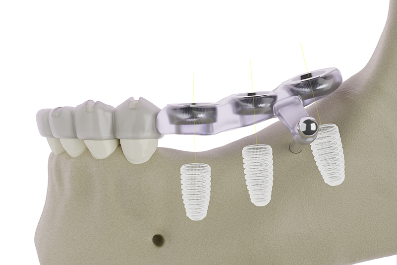 Integração de software 3D no planeamento de cirurgia de implantes