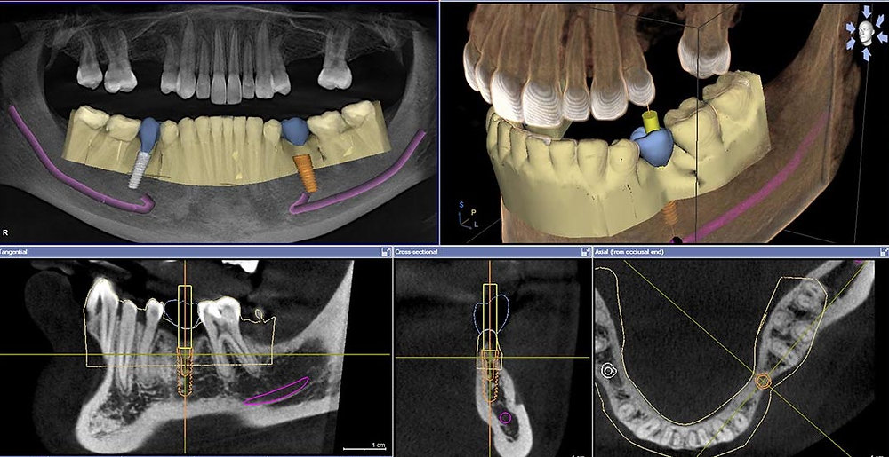 Execução clínica e kit cirúrgico utilizado na cirurgia guiada de implantes