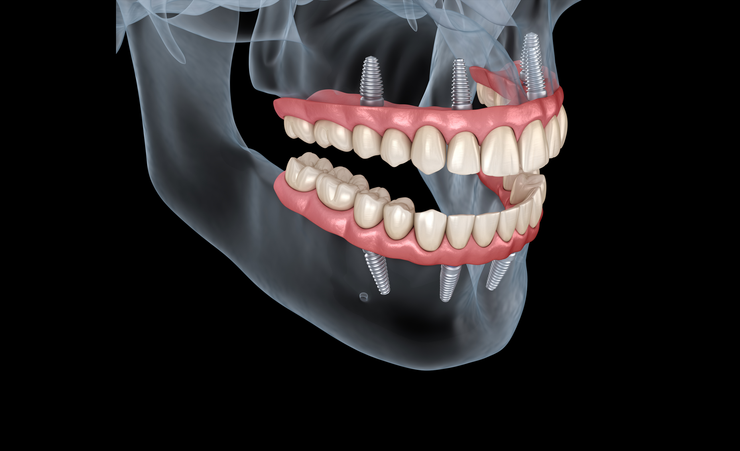 Cirurgia Guiada em Desdentados Totais