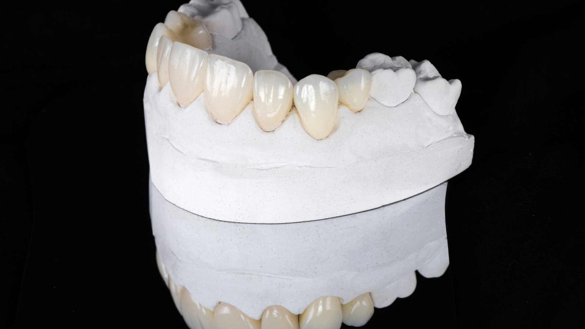 Planeamento digital de facetas e coroas com definição de eixo de inserção no Exocad