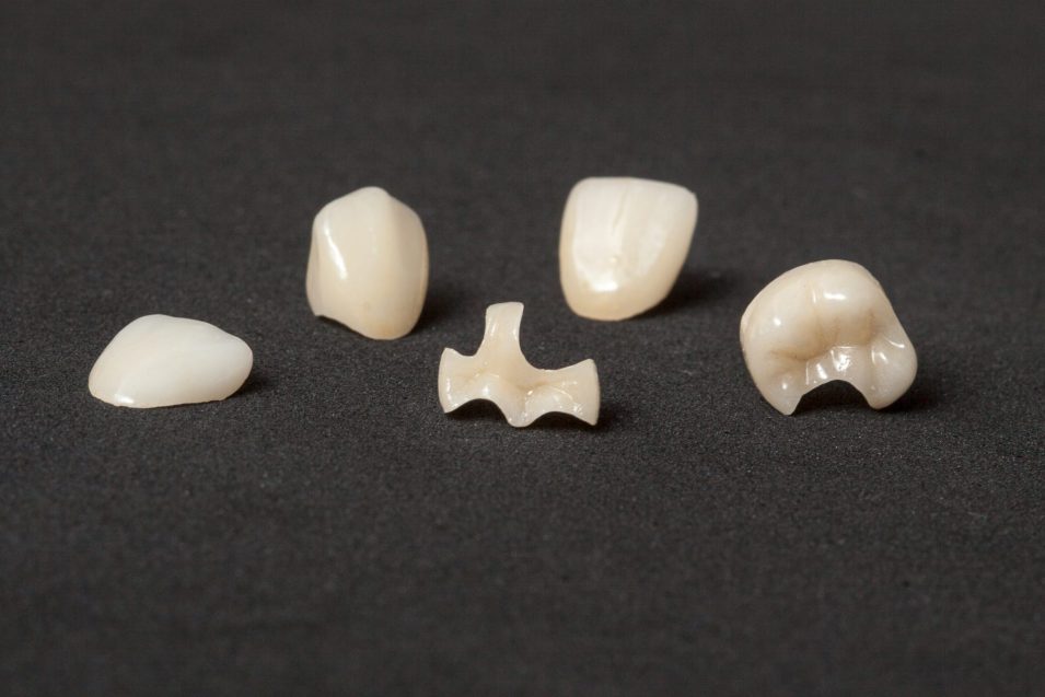 Design de facetas, inlays e onlays com margens de cimentação no Exocad