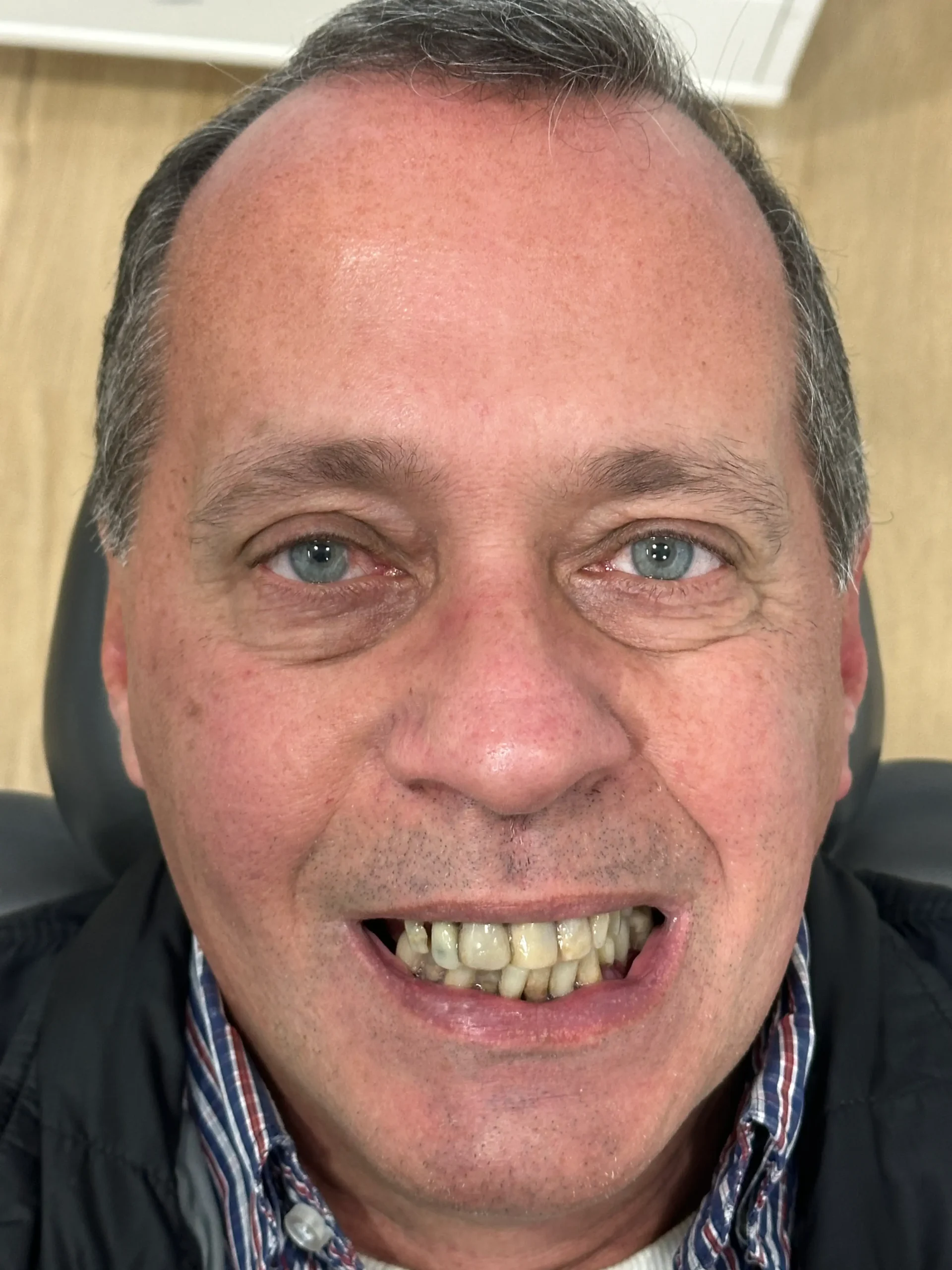Arcada dentária antes da reabilitação All-on-4 — dentes com prognóstico comprometido a extrair na mesma sessão cirúrgica