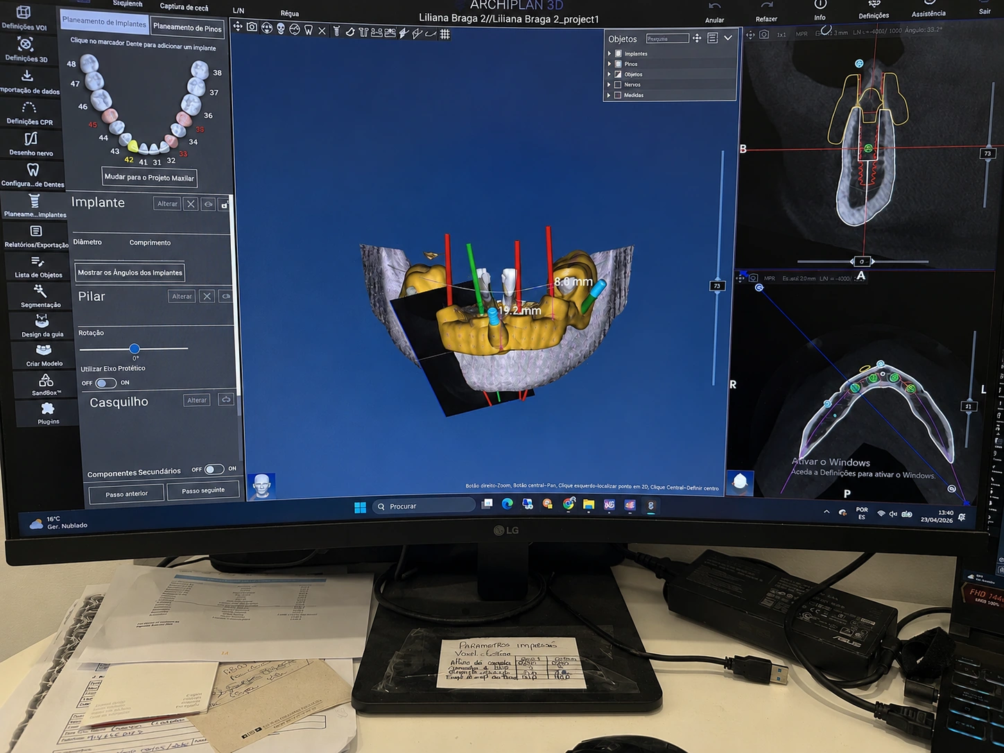 Planeamento digital do protocolo All-on-4 — simulação da posição, angulação e profundidade dos quatro implantes em software cirúrgico