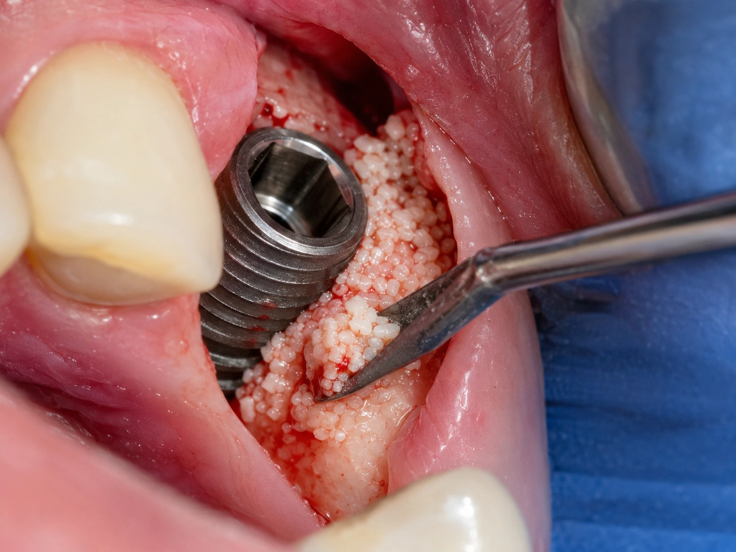 Enxerto ósseo particulado a ser colocado no gap entre implante dentário e parede alveolar — gestão do espaço buccal pós-extração