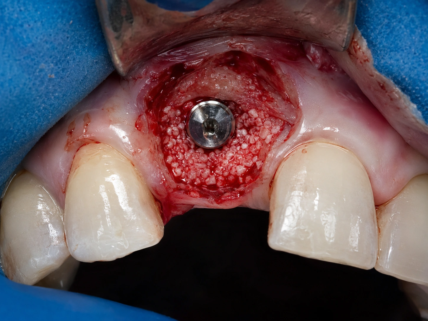 Implante dentário colocado em alvéolo pós-extração — protocolo de implante imediato