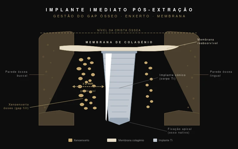 Diagrama de corte sagital do alvéolo pós-extração: implante cónico, gap buccal ≥ 2 mm preenchido com xenoenxerto e membrana de colagénio