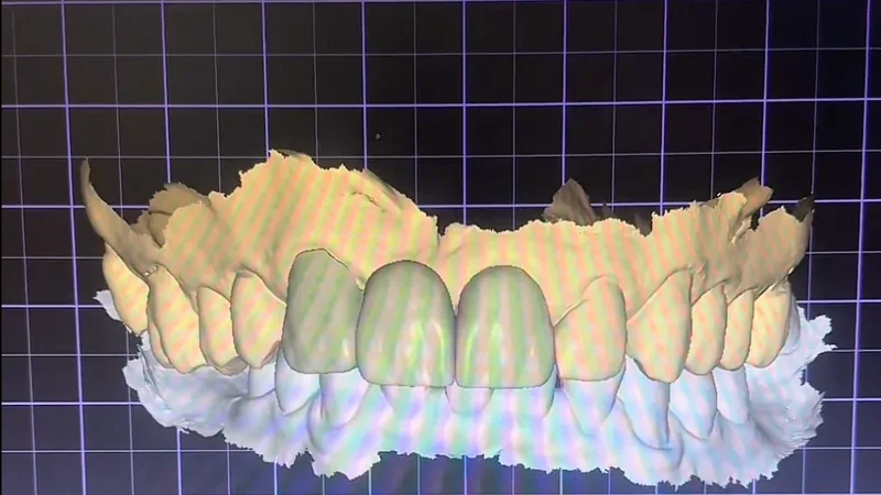 Digitalização intraoral de preparo dentário para restauração em sessão única