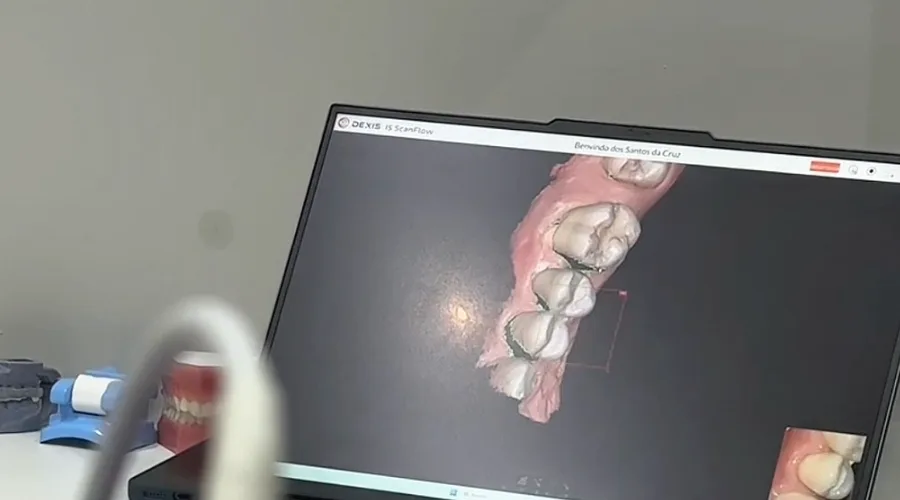 Restauração dentária concluída na mesma sessão através de fluxo digital chairside